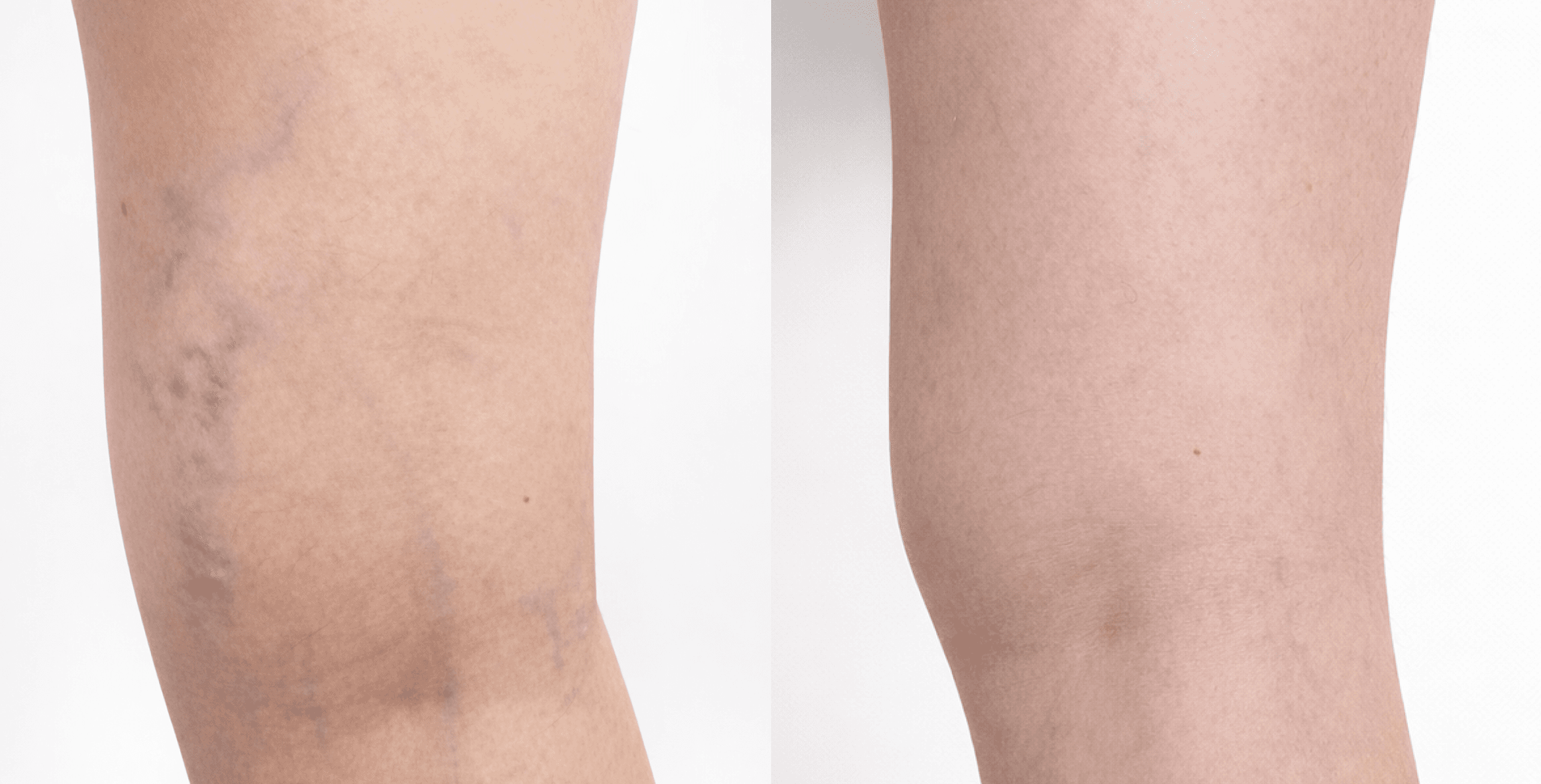 Лікування варикозної хвороби нижньої кінцівки